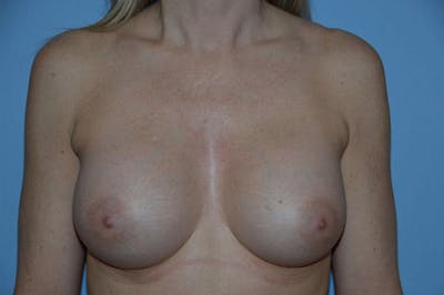 Breast Augmentation Before & After Gallery - Patient 173567718 - Image 2