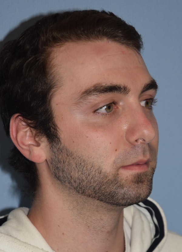Rhinoplasty Before & After Gallery - Patient 173567723 - Image 6