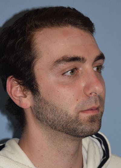 Rhinoplasty Before & After Gallery - Patient 173567723 - Image 6