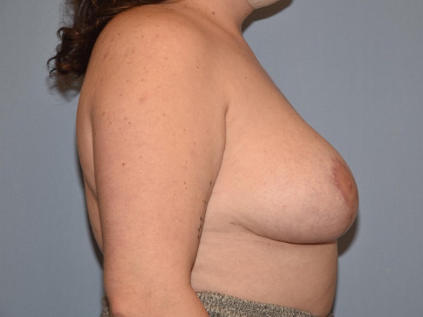 Breast Reduction Before & After Gallery - Patient 173567724 - Image 6