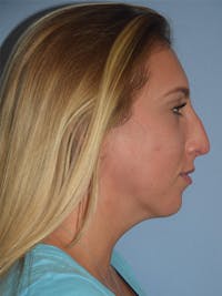 Rhinoplasty Before & After Gallery - Patient 173567746 - Image 1