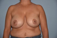 Breast Reduction Before & After Gallery - Patient 173567751 - Image 1