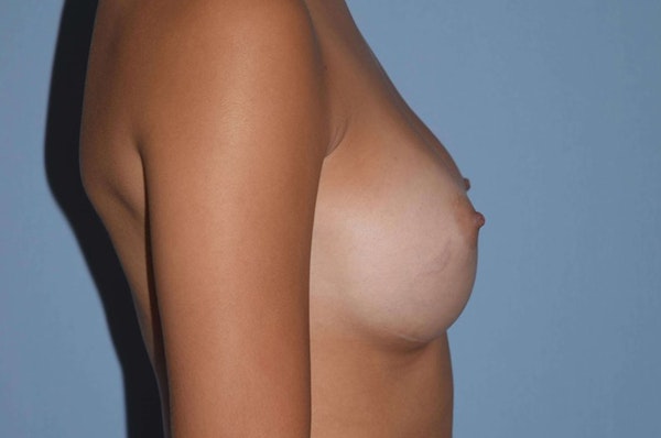 Breast Augmentation Before & After Gallery - Patient 173567744 - Image 6