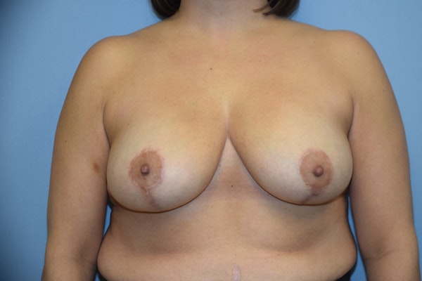 Breast Reduction Before & After Gallery - Patient 173567751 - Image 2