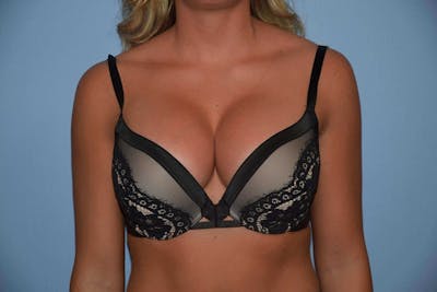 Breast Augmentation Before & After Gallery - Patient 173567747 - Image 8