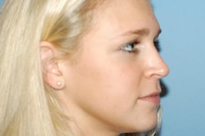 Rhinoplasty Before & After Gallery - Patient 173567748 - Image 6