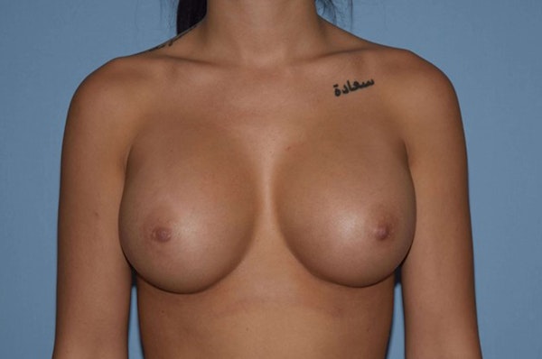 Breast Augmentation Before & After Gallery - Patient 173567750 - Image 2