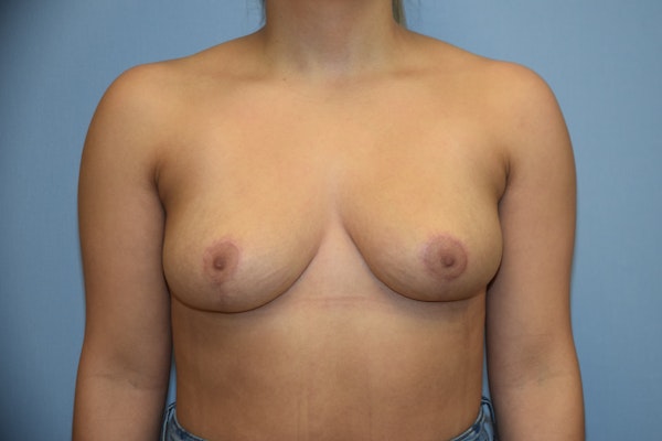 Breast Reduction Before & After Gallery - Patient 173567769 - Image 2