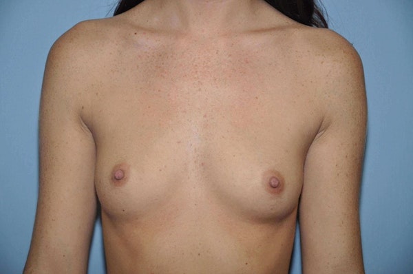 Breast Augmentation Before & After Gallery - Patient 173568327 - Image 1