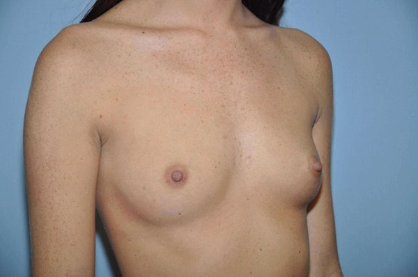 Breast Augmentation Before & After Gallery - Patient 173568327 - Image 3