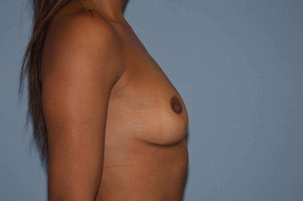 Breast Augmentation Before & After Gallery - Patient 173568331 - Image 5