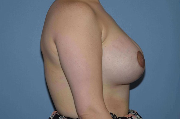 Breast Augmentation Before & After Gallery - Patient 173568350 - Image 8