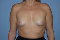 Breast Augmentation Before & After Gallery - Patient 173568359 - Image 1