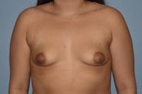 Breast Augmentation Before & After Gallery - Patient 173568362 - Image 1