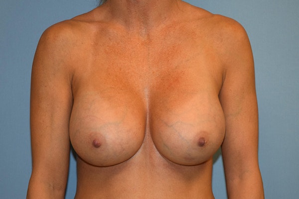Breast Augmentation Before & After Gallery - Patient 173568364 - Image 2
