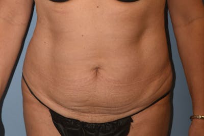 Tummy Tuck Before & After Gallery - Patient 173568463 - Image 1