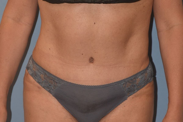 Tummy Tuck Before & After Gallery - Patient 173568463 - Image 2