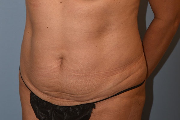 Tummy Tuck Before & After Gallery - Patient 173568463 - Image 3