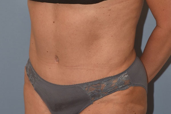 Tummy Tuck Before & After Gallery - Patient 173568463 - Image 4