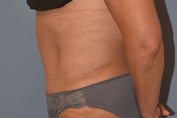 Tummy Tuck Before & After Gallery - Patient 173568463 - Image 6