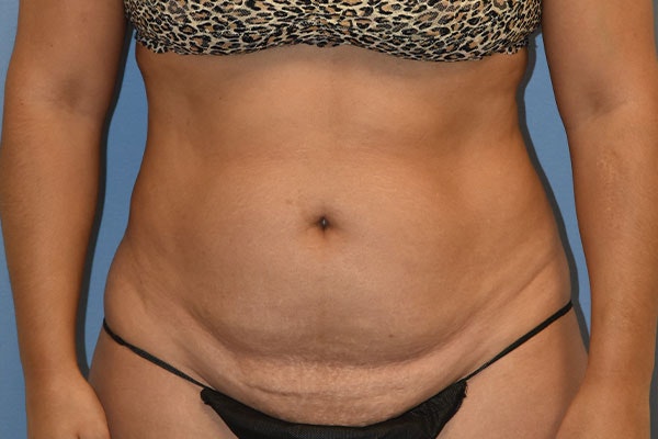 Liposuction Before & After Gallery - Patient 173568649 - Image 1