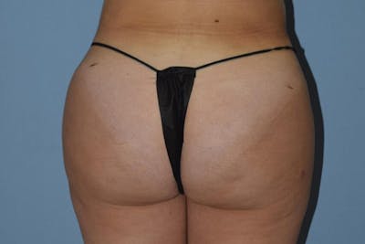 Brazilian Butt Lift Before & After Gallery - Patient 173568588 - Image 2