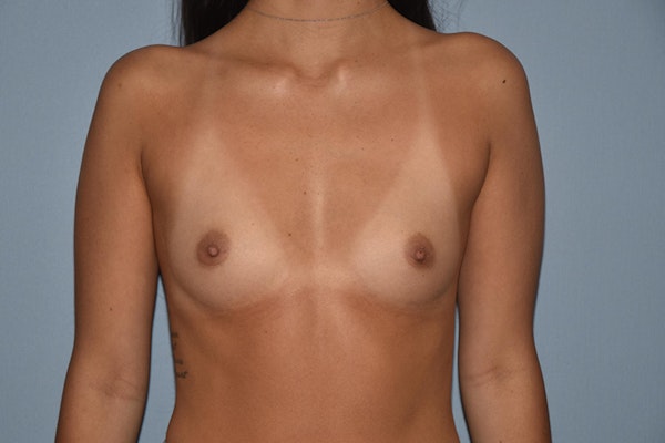 Breast Augmentation Before & After Gallery - Patient 173568674 - Image 1