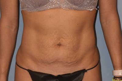 Tummy Tuck Before & After Gallery - Patient 173568803 - Image 1
