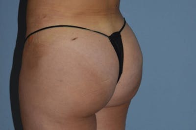 Brazilian Butt Lift Before & After Gallery - Patient 173568588 - Image 4