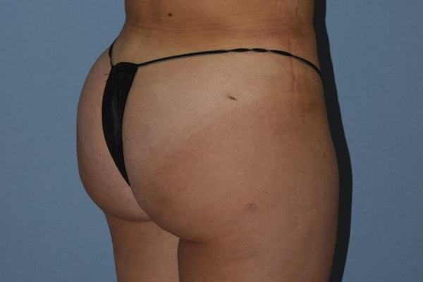 Brazilian Butt Lift Before & After Gallery - Patient 173568588 - Image 6