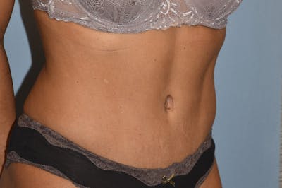 Tummy Tuck Before & After Gallery - Patient 173568803 - Image 4