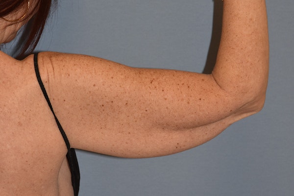 Arm Lift Before & After Gallery - Patient 173568747 - Image 1