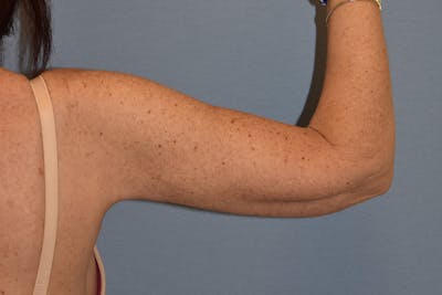 Arm Lift Before & After Gallery - Patient 173568747 - Image 2
