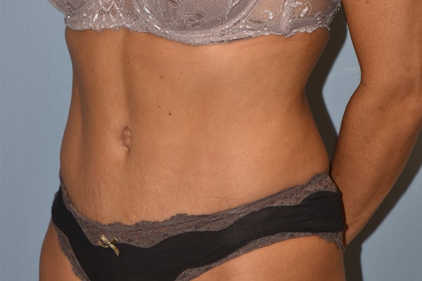 Tummy Tuck Before & After Gallery - Patient 173568803 - Image 6