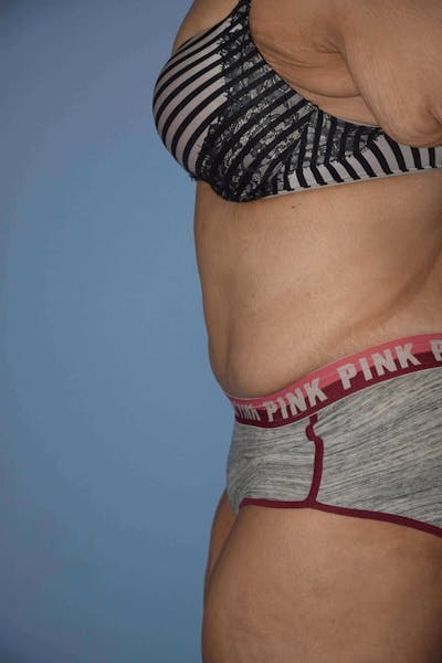 After Weight Loss Surgery Before & After Gallery - Patient 173568782 - Image 6