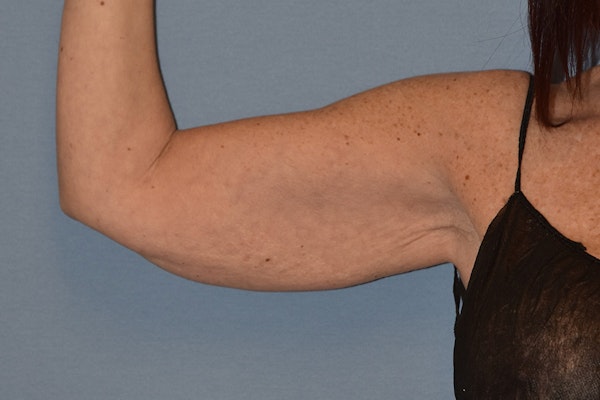 Arm Lift Before & After Gallery - Patient 173568747 - Image 3