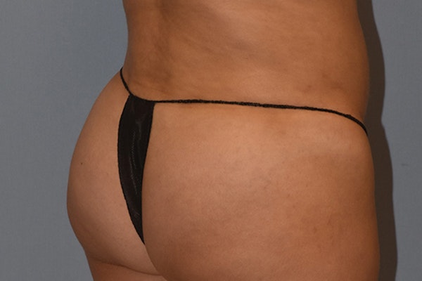 Brazilian Butt Lift Before & After Gallery - Patient 173568794 - Image 4