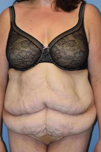After Weight Loss Surgery Before & After Gallery - Patient 173568934 - Image 1