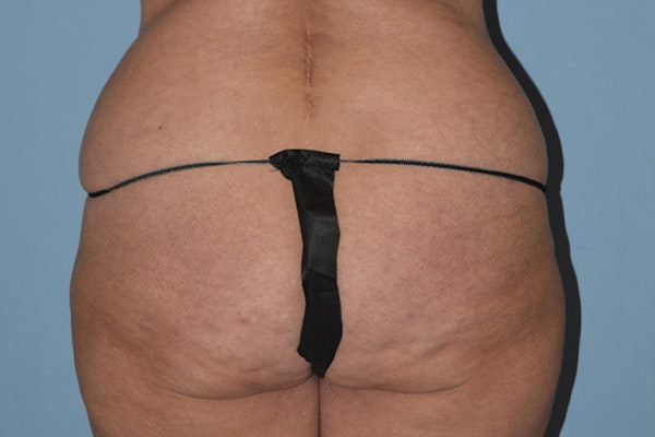 Brazilian Butt Lift Before & After Gallery - Patient 173568944 - Image 1