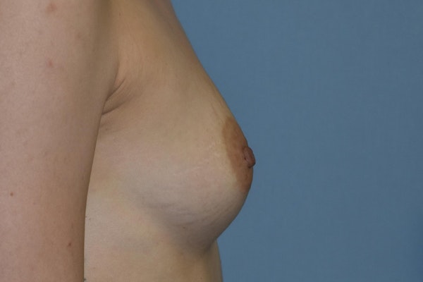 Breast Augmentation Before & After Gallery - Patient 173568876 - Image 5