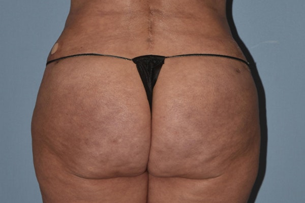 Brazilian Butt Lift Before & After Gallery - Patient 173568944 - Image 2