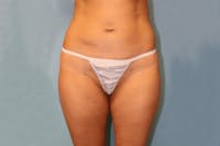 Liposuction Before & After Gallery - Patient 173568914 - Image 1