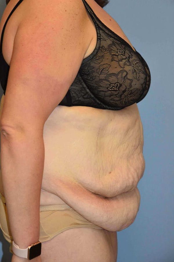 After Weight Loss Surgery Before & After Gallery - Patient 173568934 - Image 3