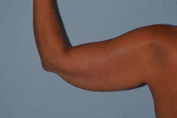 Arm Lift Before & After Gallery - Patient 173568900 - Image 3