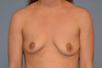 Breast Augmentation Before & After Gallery - Patient 173568948 - Image 1