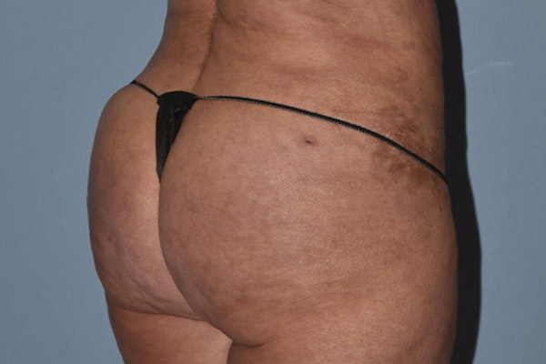 Brazilian Butt Lift Before & After Gallery - Patient 173568944 - Image 4