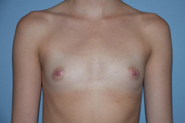 Breast Augmentation Before & After Gallery - Patient 173568947 - Image 1