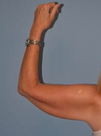 Arm Lift Before & After Gallery - Patient 173568946 - Image 1