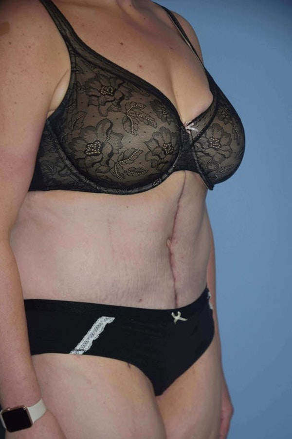 After Weight Loss Surgery Before & After Gallery - Patient 173568934 - Image 6