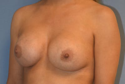 Breast Augmentation Before & After Gallery - Patient 173568948 - Image 4